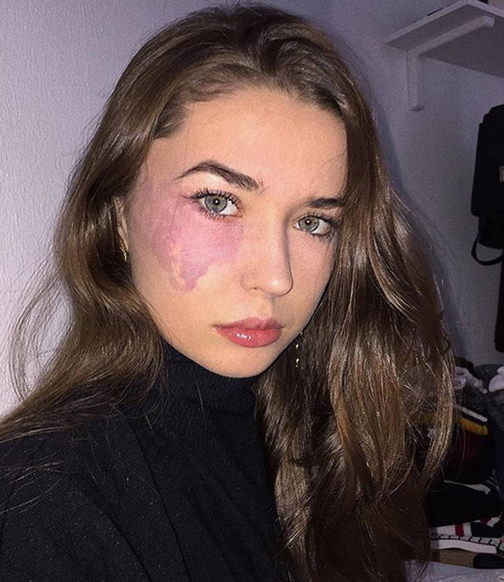 Το κορίτσι με το σημάδι στο πρόσωπο στέλνει το πιο ωραίο μήνυμα