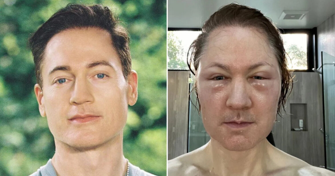 Ο εκκεντρικός εκατομμυριούχος Μπράιαν Τζόνσον έκανε ενέσεις λίπους στο πρόσωπό του και κατέληξε… παραμορφωμένος